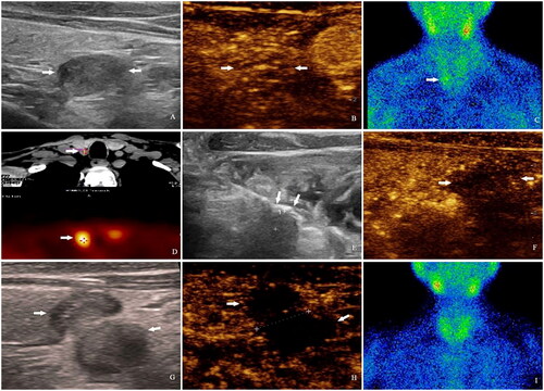 Figure 1. Ultrasound-guided microwave ablation of tertiary hyperparathyroidism in a 48-year-old male patients with successfully renal transplantation. (A) Two-dimensional ultrasonography revealed a hypoechoic nodule with a diameter of 14 mm was located posterior to the lower part of right lobe of thyroid before microwave ablation (MWA). (B) Contrast-enhanced ultrasound showed the nodule with heterogeneous iso-enhancement. (C) MIBI scan showed the nodule with increased radioactivity concentration in the late phase. (D) SPECT/CT fusion imaging revealed a low-density nodule posterior to the inferior pole of right lobe of the thyroid, which showed a localized increase in 99mTc-MIBI uptake at 1 h after 99mTc-MIBI injection. (E) The nodules were filled with gas-like hyperechoic during MWA. (F) Contrast-enhanced ultrasound (CEUS) preformed immediately after MWA showed a non-enhancement area complete covered the nodule. (G) The arrows on the left side of figures G and H indicated the inferior aspect of thyroid gland that has been damaged by MWA, and the arrows on the right side showed the alterations observed after the MWA of hyperplastic nodule in the parathyroid gland, which were both presented as hypoechoic on two-dimensional ultrasound, and no enhancement on CEUS one month later. (I) One year later, MIBI showed that the radiation distribution was uniform in the thyroid region, and there was no localized increase in 99mTc uptake around the thyroid gland or in the upper mediastinal region.
