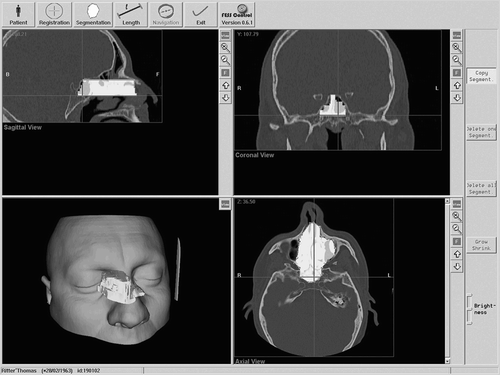 Figure 5. The preoperative planning module allows visualization of the axial, coronal and sagittal views of the 3D surface and enables the definition of a working space for the shaver.