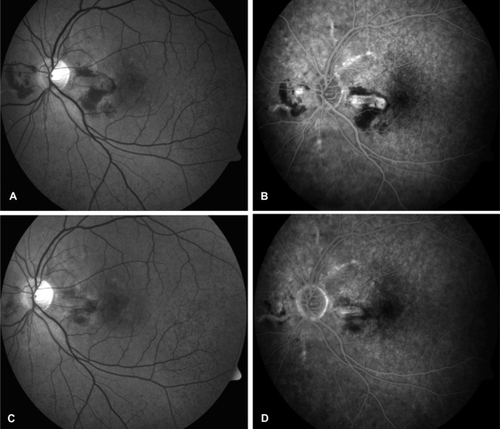 Figure 1 Left eye of patient 2. Black and white red-free photo A) shows peripapillary subretinal hemorrhages, and fluorescein angiography (FA) B) reveals the leakage from the neovascular complex (papillomacular region, and nasal to the optic disc), before receiving PDT/IVTA (best-corrected visual acuity 20/32 [0.2 LogMAR]). Twelve months after the 1st combined treatment (6 months after the 2nd combined treatment), best-corrected visual acuity was 20/63 (0.5 LogMAR), the red-free photo C) shows absorption of blood, and FA D) discloses a decrease in fluorescein leakage after regression of choroidal neovascularization.