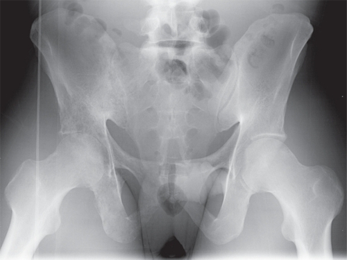 Figure 1 Pelvic radiograph. This pre-treatment radiograph demonstrates a diffuse lytic process within the right iliac wing extending into the acetabulum and right pubic rami.
