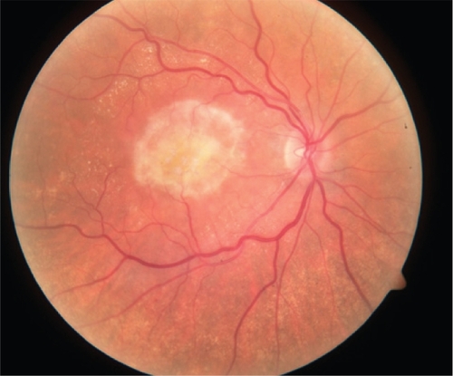 Figure 4 Disciform scarring of right eye. This end-stage of choroidal neovascularization is represented subretinal fibrosis and photoreceptor loss.