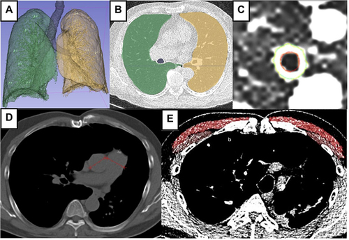 Figure 1 QCT evaluation using 3D slicer software. (A and B) Density evaluation based on %LAA−950 after lung segmentation to define emphysema. (C) Airway evaluation in the third generation of the right lung resulting in %WA. (D) An HRCT axial view, mediastinum window to measure PA:A ratio and (E) Measurement PMA and PMD on the level right above the aortic arch showing pectoralis muscle segmentation (bright red = major pectoralis muscle; brownish red = minor pectoralis muscle).