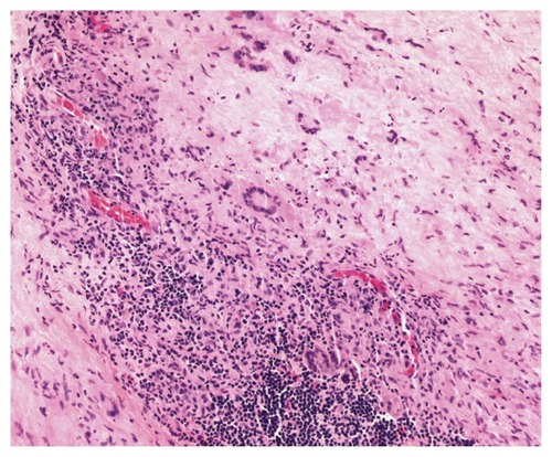 Figure 3 Hematoxylin and eosin stain of conjunctival biopsy demonstrating giant cells predominantly of the Touton type with leukemic cell infiltration of tissues.