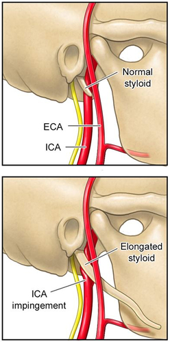 Figure 3 Impingement of internal carotid artery (ICA) due to elongated styloid process (Eagle’s syndrome).