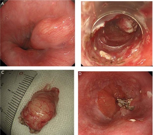 Figure 1 Endoscopic findings using submucosal tunneling technique of tumor enucleation in a SET located in the esophagogastric junction.