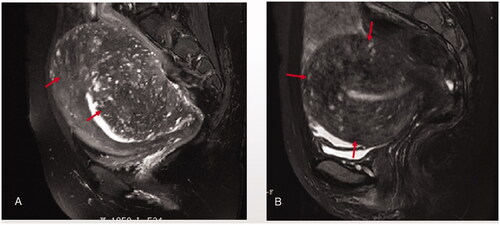 Figure 4. Full thickness adenomyosis: the lesion (red arrow heads) occurred in both the uterine inner layer and outer layer. A. asymetric full thickness adenomyosis; B. symmetric full thickness adenomyosis.