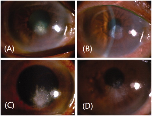 Figure 1. Case 1 presentation. (A) Slit-lamp microscopic images showing a dense, whitish, elevated inferior paracentral corneal ulcer, associated with corneal edema and localized necrosis at its periphery of the right eye cornea. (B) Fourteen days after therapy, slit-lamp microscopic images showing a quiet stromal scar with resolved corneal lesion. Case 2 presentation. (C) Slit-lamp microscopic images showing a paracentral corneal ulcer (2 × 2 mm), associated with “fluffy”-appearing infiltrates and feathered borders. (D) Fourteen days after therapy, slit-lamp microscopic images showing a faint stromal scar with corneal ulcer subsided.