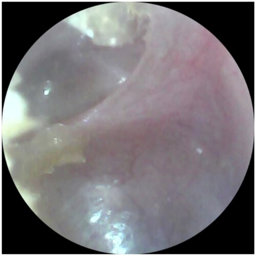 Figure 6. Right ear otoscopy six months after surgery. The contralateral ear had the same appearance.