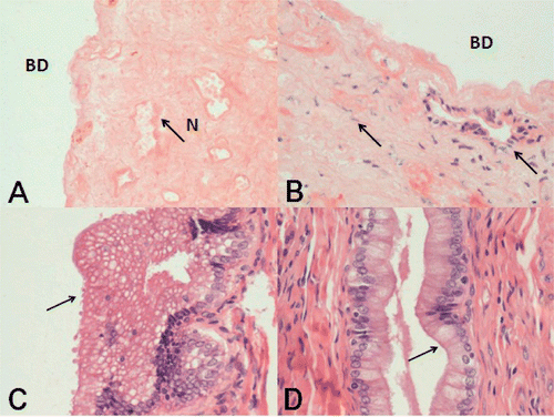 Figure 3. Histopathological examinations in the different study groups. (A) Histological appearance (H&E) of the necrotic bile duct (BD) wall after hepatic RFA in group I. Liver removal was performed 2 weeks after RFA. There was total destruction of epithelial cells and the subepithelial glands of the bile ducts. The bile duct wall showed full thickness necrosis, with extensive cytolysis, karyolysis, collagen degeneration, fibrosis and hyalinisation, and loss of bile duct histological structure. Necrosis (N) of the entire bile duct wall was evident (original magnification HE × 200). (B) Histological appearance of incomplete necrosis of the bile ducts in samples from group 2. The bile duct walls showed partial thickness necrosis, the epithelium was dislocated, collagen fibers were swollen and hyperplastic, and fibroblasts were infiltrating. However, part of the glandular structure remained (original magnification H&E × 200). (C) Most samples from group III showed vacuolar changes within the epithelial cytoplasm (original magnification H&E × 400). (D) There were no relevant changes in the epithelium of bile duct samples from group IV animals (original magnification H&E × 400).