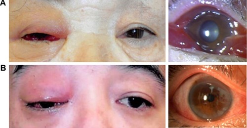 Figure 1 Representative facial photos of two cases with IOI who presented with eyelid erythema, eyelid swelling and conjunctival hyperemia.Notes: (A) A 73-year-old female and (B) a 51-year-old male. They were initially misdiagnosed as orbital cellulitis, however, antibiotics were ineffective. Their symptoms were rapidly resolved by systemic steroids, thus suggesting that they were suffering from IOI and not from orbital cellulitis.