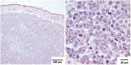 Figure 2. Low (10×, left) and high (100×, right) magnification photomicrographs of a MTGB female mouse mammary adenocarcinoma accessed 24 h following systemically administered cisplatin at 5 mg/kg body weight. Although some tumour cells remain morphologically normal, the majority of the cells have a reduced volume and both apoptotic and necrotic cells are present. H&E stain.