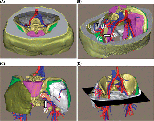 Figure 5. 3D reconstruction of the tumor region for patient 2. (A) Superior view of the entire 3D model of the tumor region. (B) Superior view with some structures cut away to show the spatial relationships between the tumor and peritumoral structures: (1) gluteus maximus; (2) gluteus medius; (3) gluteus minimus; (4) superior gluteal vessels. (C) Posterior view with some structures removed: (5) piriformis; (6) inferior gluteal vessels. (D) Oblique view accompanied by an axial slice of the fused images. Based on the 3D reconstruction, the shape, size, location and extent of the tumor are depicted in detail.