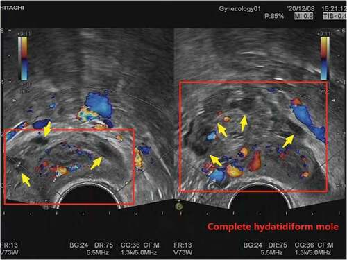 Figure 1. The ultrasound image of the patient. B-ultrasound showed a honeycomb, small round fluid dark area, and cloud-like hypoechogenic areas in the uterine cavity (inside the red box, referred to by the yellow arrow).