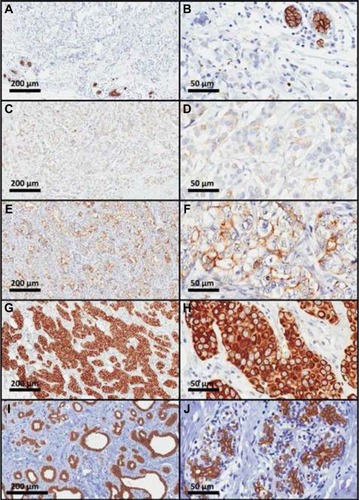 Figure 3 Photomicrographs of ABCB1 immunostaining in human mammary tissue samples showing different immunoreaction intensities.