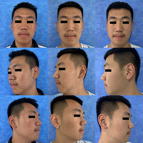 Figure 2 Comparison of different parts of the face in case 1 during treatment. The horizontal photos are the comparison of the same part at different visits (from left to right: September 11th, 2021, September 25th, 2021, and October 6th, 2021); the longitudinal photos are of different parts at the same visit (from top to bottom: the front face, left face and right face).