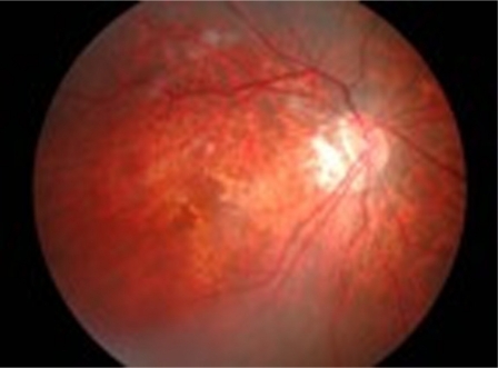 Figure 3 Right fundus showed the subretinal hemorrhage became less dense and reducing in size at one week post intravitreal ranibizumab.