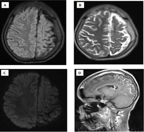 Figure 3 Magnetic Resonance imaging of the brain which shows left cerebral hemisphere, prominent atrophic changes at the sulcus and fissures of the parietal lobe and thickening of the adjacent of the left parietal lobe are noteworthy (A and B). There is no diffusion restriction (C). After Intravenous contrast injection (D). There is gyral-meningeal contrast enhancement in the cortical regions in the areas described of the left parietal lobe.