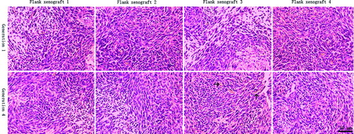 Figure 3  Histopathologic features of flank xenografts. Compared with the human surgical materials, GBM xenografts in 4 different xenograft lines displayed pleomorphic cells, presence of mitotic activity, necrotic foci, and mild microvasculars (black arrow), but endothelial proliferation with multilayering of endothelial cells was not observed.