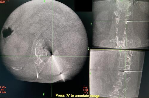 Figure 4 Accurate puncture to the fissure during surgery.
