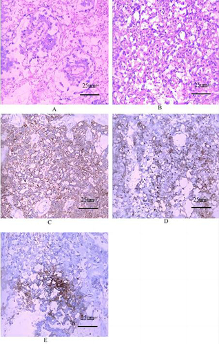 Figure 6 Pathology of yolk sac tumor (moderate H&E staining) (A) S-D corpuscles; (B) vitreous corpuscles; immunohistochemistry (moderate H&E staining): (C) CK positive; (D) Glypican-3 positive; (E) PLAP positive.