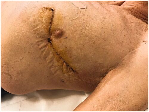 Figure 3. At one month post-op the flap was completely consolidated with the thoracic tissues, scars were well healed and no distortion of the thoracic surface was noted.
