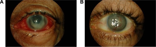 Figure 2 (A) A case in group B before treatment; (B) after treatment.