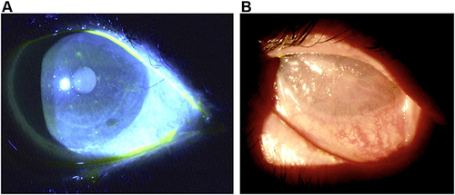 Figure 1 Slit lamp photographs at presentation. (A) Dense punctate epithelial erosions are seen after fluorescein staining of the patient’s right eye along with a couple of trichiatic lashes. (B) Total limbal stem cell deficiency with complete corneal conjunctivalization and symblepharon formation is seen in the patient’s left eye.