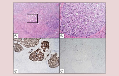 Figure 4. Mircroscopic Features. Hematoxylin and eosin at 20× original magnification (A). Hematoxylin and eosin at 100× original magnification (at box inset from A) (B). Glypican-3 highlights the small size and multiplicity of the tumors (20× original magnification) (C). Low MIB-1 proliferation index (20× original magnification) (D).