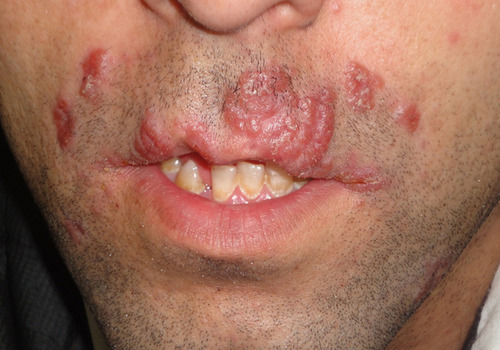 Figure 1 Multiple separated hyperkeratotic nodular lesions with erythematic and prominent borders on the patient’s face.