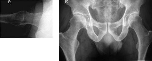 Figure 37. AP pelvis and axial radiograph of 48 year old male (no history or symptoms of neuromuscular disease): coxa valga, long femoral neck, a shallow acetabulum with global retroversion (confirmed by CT) and round femoral heads, i.e. an orangutan hip, compare with far left radiograph of Figure 36.