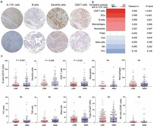 Figure 4. Association of IL-17A+ cells and various tumor-infiltrating immune cells. (a) Representative immunochemistry staining of B cells, Dendritic cells and CD8+ T cells in IL-17A+ cells high tumors and in IL-17A+ cells low tumors. (b) Pearson correlation analysis of IL-17A+ cells with other tumor-infiltrating lymphocytes. (c) Differences in tumor-infiltrating lymphocytes between IL-17A+ cells high tumors and IL-17A+ cells low tumors