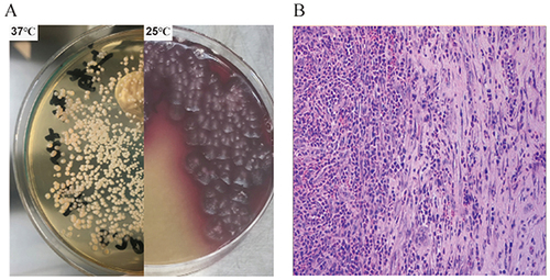 Figure 2 (A) Talaromyces marneffei was isolated from the BALF: Yellow colony on Sabouraud’s dextrose slant at 37°C in left, and yellow colony with distinctive red diffusible pigment on Sabouraud’s dextrose slant at 25°C in right. (B) Histopathology of the right occipital lobe mass: Microscopic examination of brain tissue revealed areas of necrotic tissue and granulation tissue formation, accompanied by significant neutrophil infiltration, which is indicative of a chronic brain abscess.