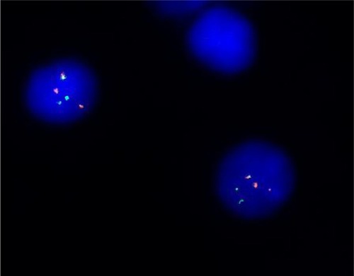 Figure 2 FISH analyses with Bcr and Abl probes.