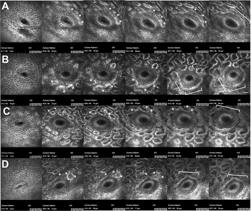 Figure 2 Images of progressive volumetric scans of lid margin rete ridges in continuity with Meibomian gland basement membrane and basal epithelium using in vivo confocal microscopy (IVCM). Each meibomian gland orifice (A–D) demonstrates individual orifice associated rete ridges in peri-lumenal position (white asterisks) ovalize, flatten, and appear to coalesce with adjacent rete ridges to form the Meibomian gland basement membrane and ductal basal epithelium with increased depth (white bracket). Scale bar, 50µm.