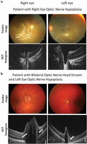 Figure 5. Fundus images (top) and SD-OCT horizontal B-scans (bottom) through the center of the disc in (A) a patient with right eye optic nerve hypoplasia (ONH) and (B) bilateral optic nerve head drusen (ONHD) with ONH in the left eye. Arrows indicate the position of the drusen above the edges of the RPE. The disc size of the left eye with both ONHD and ONH is considerably smaller than in the unaffected eye. Reprinted with permission from [Citation13], licensed under https://creativecommons.org/licenses/by-nc-nd/4.0/.