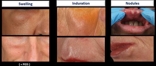 Figure 30 The clinical spectrum of LOAEs includes inflammatory or non-inflammatory manifestations, including swelling, induration, and nodules. Onset is usually after > 4 weeks.