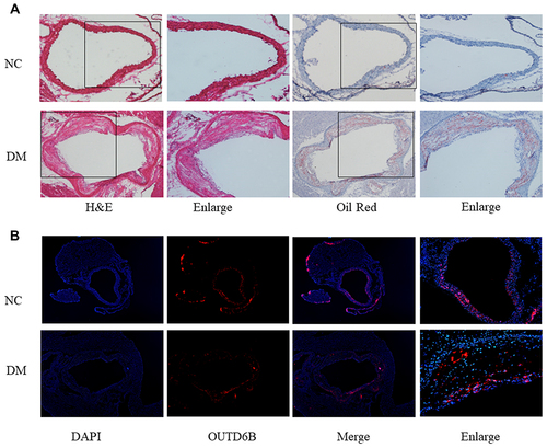 Figure 3 Diabetes decreases the expression of OUTD6B in ApoE−/− mice. (A) Representative images of aortic sections stained with H&E, Oil Red O from ApoE−/− mice. (B) Immunofluorescence staining showing the expression of OTUD6B in aortic diabetic atherosclerotic plaques. Blue-stained areas the nuclei; red-stained areas represent OTUD6B.
