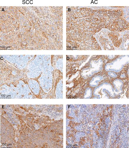 Figure 1 Representative immunohistochemical staining of B7 homolog 3 (B7-H3) and programmed cell-death ligand 1 (PD-L1) in squamous cell carcinoma (SCC) (left column) and adenocarcinoma (AC) (right column) of the cervix. Positive B7-H3 in tumor cells and stromal cells (A and B), negative B7-H3 in tumor cells and positive B7-H3 in stromal cells (C and D), and positive PD-L1 as defined by a combined positive score of ≥1 (E and F).