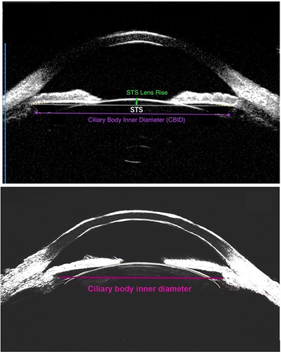 Figure 3 Ultrasound Biomicroscopy Images of Posterior Chamber Structures with Specific Measurements Used in Nomograms. The bottom image depicts ArcScan Insight® Ultrasound Biomicroscopy. Reprinted from Ruan et al. Creative Commons.Citation20