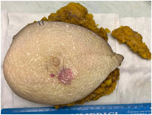 Figure 1. Gross examination shows a small purple skin lesion with irregular margins in periareolar region in breast left inner quadrant transition and no evidence of skin ulceration.