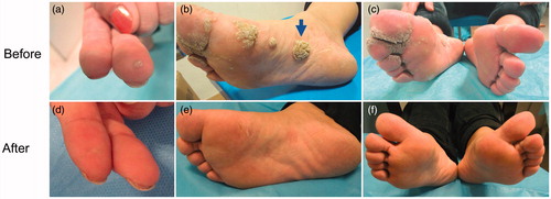 Figure 1. Extensive viral warts in a 33-year-old woman with SLE. Warty lesions before treatment (a, b, c), complete clearance of lesions ten weeks after intensive hyperthermia (d, e, f ). The targeted site is marked with a blue arrow.