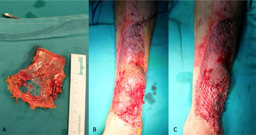 Figure 9. PAT graft application. A: 6 × 4 cm sized PAT graft was harvested from the abdominal region. B: PAT grafts were adapted to cover the exposed anterior tibial bone and tendon. C: 3:1 meshed split-thickness skin grafting was performed over PAT grafts and the rest of the defect.