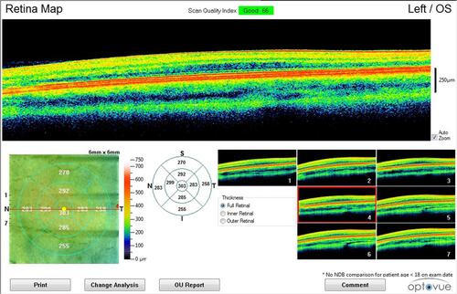 Figure 1 Retinal map for a participant with albinism showing the mean retinal thickness (µm) in the nine ETDRS sectors and the seven en face images.