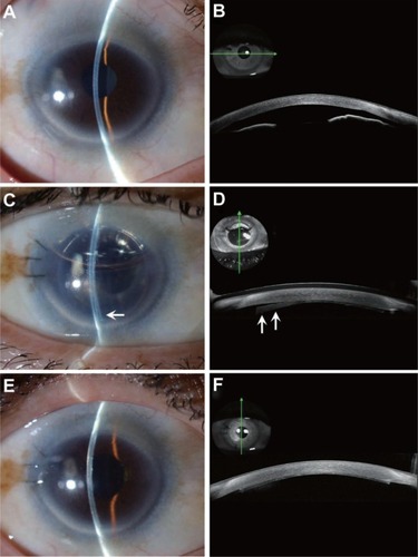 Figure 2 Slit-lamp photographs and anterior segment optical coherent tomography images in case 3. (A and B) Preoperatively, mild stromal edema and shallow anterior chamber were noted, although best-corrected visual acuity was 20/20. A flat corneal section was noted by anterior segment optical coherent tomography. (C and D) At one day postoperatively, partial donor detachment (arrow) was noted, and rebubbling was performed immediately. (E and F) At 2 months postoperatively, total donor attachment was noted.