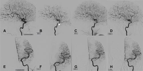 Figure 2 Angiographic follow-up via digital subtraction angiography of left ICA. (A and E) Directly after implantation of the pipeline device; (B and F) after three months; (C and G) after twelve months; (D and H) after twenty-four months. Note the transient relative hypoperfusion of the left anterior cerebral artery via left ICA three months post-interventionally that completely reversed during next follow-ups accompanied by transient intimal hyperplasia (white arrowhead).