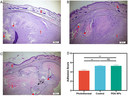 Figure 4 Histological assessment on adhesion formation (40 ×). (A) In the photothermal group, there is an interval between the skin (S) and the repaired tendon (T) at the repair site (Arrowhead), but the interval disappeared and was filled by dense scar in the control group (B) and the PDA NPs group (C). (D) Average adhesion score in the photothermal group is significantly lower than that in the control group and the PDA NPs group. The data is expressed by mean ± SEM (one-way ANOVA, p = 0.002; n = 5 per group). ** p < 0.01; ns, no significant.