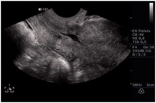 Figure 1. Transvaginal ultrasound six weeks post-surgery showed hardly any remaining dehiscence of the uterine scar.