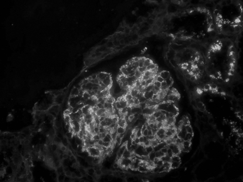 Figure 2. Immunofluorescence staining for IgA showing 2+ granular deposition in mesangium and glomerular capillary loops (original magnification ×400); there is also 2+ staining for C3 in a similar pattern (not shown).