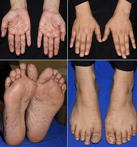 Figure 1 Clinical images showing numerous macules with different shades of brown affecting mainly the palmoplantar surfaces with some extension to the periungual areas.