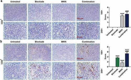 Figure 2. Combined treatment of MWA with anti-PD-1/anti-CTLA-4 increased the intratumoral infiltration of cytotoxic CD8+ T lymphocyte cell into tumors, but not CD4+ T helper cells. A: Representative microphotographs of CD4+ in Untreated group, Blockade group, MWA group and Combination group, under 100 × and 200 × magnification. Staining of immunohistochemistry was conducted on the tumor specimens harvested 7 days after the treatment. n = 5. B: Representative microphotographs of CD8+ in Untreated group, Blockade group, MWA group and Combination group, under 100 × and 200 × magnification. Staining of immunohistochemistry was performed on the tumor specimens harvested 7 days after the treatment. n = 5. Each experiment was independently conducted in triplicate